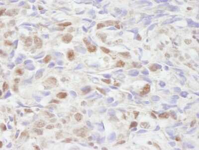 Immunohistochemistry: NCOA2 Antibody [NB100-1756] - Sample : FFPE section of human breast adenocarcinoma. Antibody : Affinity purified rabbit anti-NCOA2/SRC2 used at a dilution of 1:250. Detection : DAB