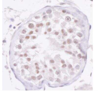 Immunohistochemistry-Paraffin: NCOA2 Antibody [NBP2-22162] -  Section of human testicular seminoma. Antibody: Affinity purified rabbit antiNCOA2/ SRC2  used at a dilution of 1:1,000 (1ug/ml). Detection: DAB.