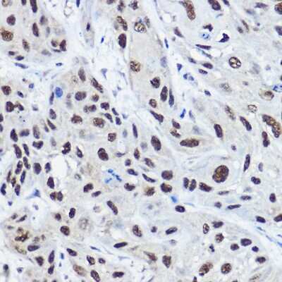 Immunohistochemistry-Paraffin: NCOA2 Antibody [NBP3-03763] - Human esophageal cancer using [KO Validated] NCOA2 Rabbit pAb (NBP3-03763) at dilution of 1:100 (40x lens). Perform high pressure antigen retrieval with 10 mM citrate buffer pH 6.0 before commencing with IHC staining protocol.