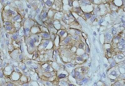 Immunohistochemistry-Paraffin: NDRG1 Antibody [NB300-839] - (0.5ug/ml) staining of paraffin embedded Human hepatocelluar carcinoma. Data obtained from C. Furer, Visceral Surgery, University of Bern, Switzerland.