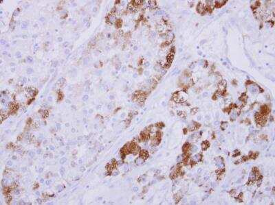 Immunohistochemistry-Paraffin: NDRG4 Antibody [NBP2-19500] -  Paraffin-embedded hepatoma. NDRG4 antibody  dilution: 1:500.