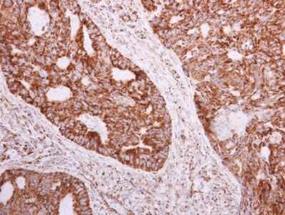 Immunohistochemistry-Paraffin: NDUFA5 Antibody [NBP1-33504] - NDUFA5 antibody detects NDUFA5 protein at mitochondria in human colon carcinoma by immunohistochemical analysis. Sample: Paraffin-embedded human colon carcinoma. NDUFA5 antibody diluted at 1:500.