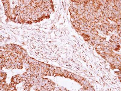 Immunohistochemistry-Paraffin: NDUFAB1 Antibody [NBP2-19502] - Immunohistochemical analysis of paraffin-embedded Colon ca, using antibody at 1:250 dilution.
