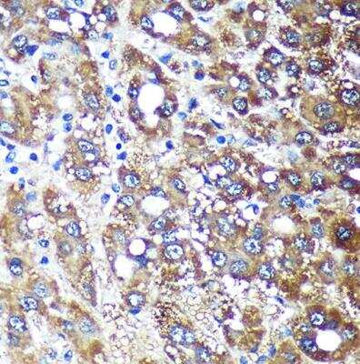 Immunohistochemistry-Paraffin: NDUFAF4 Antibody [NBP2-93264] - Human liver cancer using NDUFAF4 Rabbit pAb (A14345) at dilution of 1:100 (40x lens).