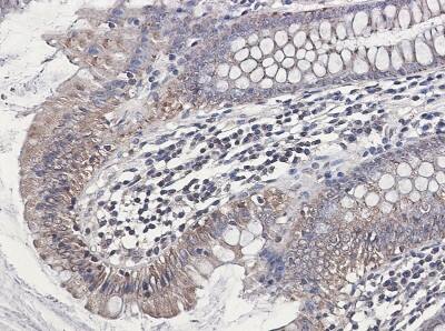 Immunohistochemistry-Paraffin: NDUFB1 Antibody (S04-4H3) [NBP3-19813] - Immunohistochemistry of NDUFB1 in paraffin-embedded Human colon cancer tissue using NBP3-19813 at dilution 1/50