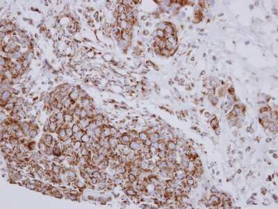 Immunohistochemistry-Paraffin: NDUFB10 Antibody [NBP2-19503] - Human breast cancer, using NDUFB10 antibody at 1:250 dilution.  Antigen Retrieval: Trilogy™ (EDTA based, pH 8.0) buffer, 15min