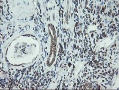 Immunohistochemistry: NDUFB10 Antibody (OTI1H6) [NBP2-46118] - Analysis of Carcinoma of Human kidney tissue.