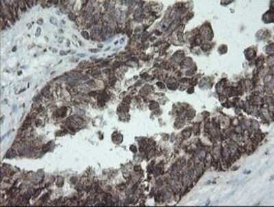 Immunohistochemistry: NDUFB10 Antibody (OTI1H6) [NBP2-46118] - Analysis of Adenocarcinoma of Human ovary tissue.