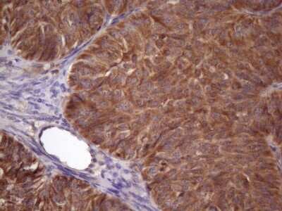 Immunohistochemistry: NDUFB11 Antibody (9C5) [NBP2-46119] - Analysis of Adenocarcinoma of Human ovary tissue. (Heat-induced epitope retrieval by 1 mM EDTA in 10mM Tris, pH8.5, 120C for 3min)