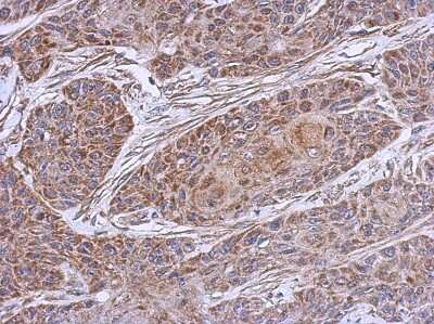 Immunohistochemistry-Paraffin: NDUFB4 Antibody [NBP2-15035] - Paraffin-embedded Cal27 xenograft, using antibody at 1:500 dilution.