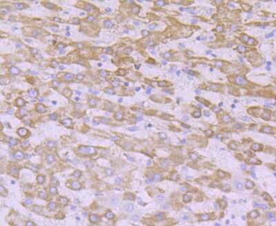Immunohistochemistry-Paraffin: NDUFB8 Antibody (JG61-36) [NBP2-75586] - Analysis of paraffin-embedded human liver cancer tissue using anti-NDUFB8 antibody. Counter stained with hematoxylin.