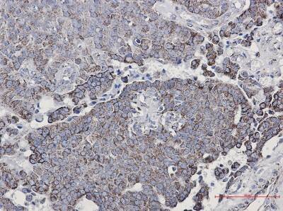 Immunohistochemistry-Paraffin: NDUFC2 Antibody (S05-2C2) [NBP3-19710] - Immunohistochemistry of NDUFC2 in paraffin-embedded Human breast cancer tissue using NBP3-19710 at dilution 1/50