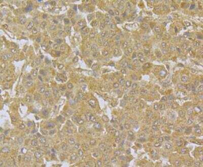 Immunohistochemistry: NDUFS3 Antibody [NBP2-76953] - Immunohistochemical analysis of paraffin-embedded human liver cancer tissue using anti-NDUFS3 antibody. Counter stained with hematoxylin.
