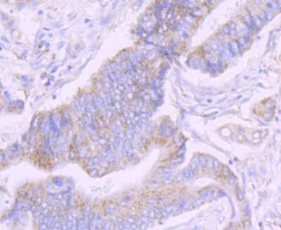 Immunohistochemistry-Paraffin: NDUFS3 Antibody (JU10-32) [NBP2-75587] - Analysis of paraffin-embedded human colon cancer tissues using anti-NDUFS3 receptor 2 antibody. Counter stained with hematoxylin.