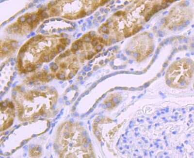 Immunohistochemistry-Paraffin: NDUFS3 Antibody (JU10-32) [NBP2-75587] - Analysis of paraffin-embedded human kidney cancer tissues using anti-NDUFS3 receptor 2 antibody. Counter stained with hematoxylin.