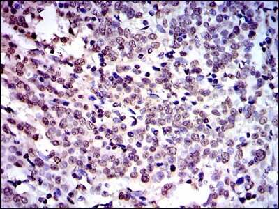 Immunohistochemistry: NEDD8 Antibody (1A7) [NBP2-37524] - Immunohistochemical analysis of paraffin-embedded cervical cancer tissues using NEDD8 mouse mAb with DAB staining.