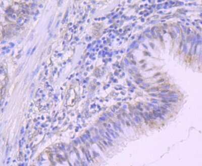 Immunohistochemistry-Paraffin: NEDD8 Antibody (JF69-09) [NBP2-66970] - Analysis of paraffin-embedded human lung cancer tissue using anti-NEDD8 antibody. Counter stained with hematoxylin.