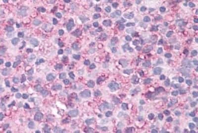 Immunohistochemistry-Paraffin: NEK6 Antibody [NBP3-14415] - Immunohistochemistry of formalin-fixed, paraffin-embedded human lymph node, non-Hodgkins lymphoma, after heat-induced antigen retrieval.