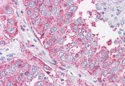Immunohistochemistry-Paraffin: NEK6 Antibody [NBP3-14415] - Immunohistochemistry of formalin-fixed, paraffin-embedded human lung, non-small cell carcinoma, after heat-induced antigen retrieval.