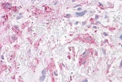 Immunohistochemistry-Paraffin: NEK6 Antibody [NBP3-14415] - Immunohistochemistry of formalin-fixed, paraffin-embedded human brain, glioblastoma, after heat-induced antigen retrieval.
