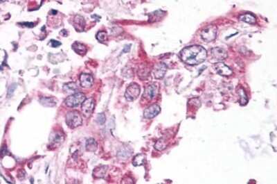 Immunohistochemistry-Paraffin: NEK6 Antibody [NLS7305] - Anti-NEK6 antibody IHC of human Pancreas, Carcinoma. Immunohistochemistry of formalin-fixed, paraffin-embedded tissue after heat-induced antigen retrieval.