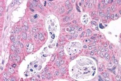 Immunohistochemistry-Paraffin: NEK6 Antibody [NLS7305] - Anti-NEK6 antibody IHC of human Colon, Carcinoma. Immunohistochemistry of formalin-fixed, paraffin-embedded tissue after heat-induced antigen retrieval.