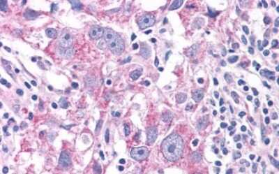 Immunohistochemistry-Paraffin: NEK6 Antibody [NLS7305] - Anti-NEK6 antibody IHC of human Breast, Carcinoma. Immunohistochemistry of formalin-fixed, paraffin-embedded tissue after heat-induced antigen retrieval.