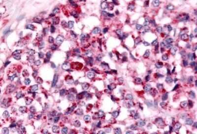 Immunohistochemistry-Paraffin: NEK7 Antibody [NLS7164] - Anti-NEK7 antibody IHC of human Breast, Carcinoma. Immunohistochemistry of formalin-fixed, paraffin-embedded tissue after heat-induced antigen retrieval.