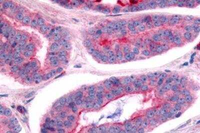 Immunohistochemistry-Paraffin: NEK7 Antibody [NLS7164] - Prostate, Carcinoma