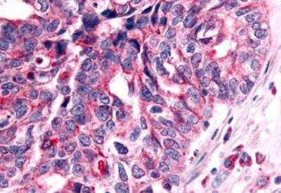 Immunohistochemistry-Paraffin: NEK7 Antibody [NLS7164] - Ovary, carcinoma