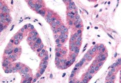 Immunohistochemistry-Paraffin: NEK9 Antibody [NBP2-31091] - Prostate carcinoma