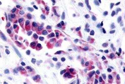 Immunohistochemistry-Paraffin: NEK9 Antibody [NBP2-31091] -  Human Breast, Carcinoma tissue after heat-induced antigen retrieval.