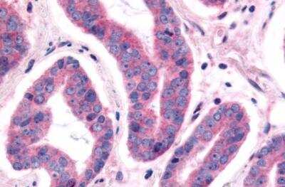 Immunohistochemistry-Paraffin: NEK9 Antibody [NBP2-31091] - Human Prostate, Carcinoma tissue after heat-induced antigen retrieval.