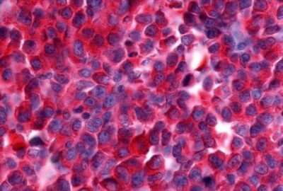 Immunohistochemistry-Paraffin: NEK9 Antibody [NLS7967] - Anti-NEK9 antibody IHC of human Lymph Node, Non-Hodgkins Lymphoma. Immunohistochemistry of formalin-fixed, paraffin-embedded tissue after heat-induced antigen retrieval.