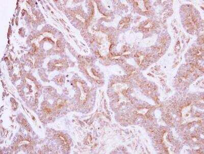Immunohistochemistry-Paraffin: NELL1 Antibody [NBP2-19511] - Human breast cancer, using NELL1 antibody at 1:250 dilution.  Antigen Retrieval: Trilogy™ (EDTA based, pH 8.0) buffer, 15min. 