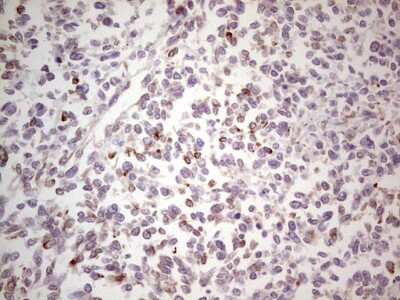 Immunohistochemistry: NF-M Antibody (2G3) [NBP2-46139] - Analysis of Human melanoma tissue. (Heat-induced epitope retrieval by 1 mM EDTA in 10mM Tris, pH8.5, 120C for 3min)