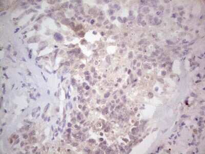 Immunohistochemistry: NF-M Antibody (2G3) [NBP2-46139] - Analysis of Human testicular cancer tissue. (Heat-induced epitope retrieval by 1 mM EDTA in 10mM Tris, pH8.5, 120C for 3min)