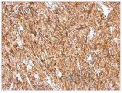 Immunohistochemistry-Paraffin: NF2/Merlin Antibody [NBP1-33531] - Paraffin-embedded RT2 xenograft, using Neurofibromin 2 antibody at 1:500 dilution.