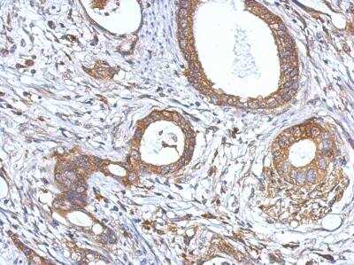 Immunohistochemistry-Paraffin: NF2/Merlin Antibody [NBP1-33531] -  Paraffin-embedded Gastric ca, using antibody at 1:500 dilution.