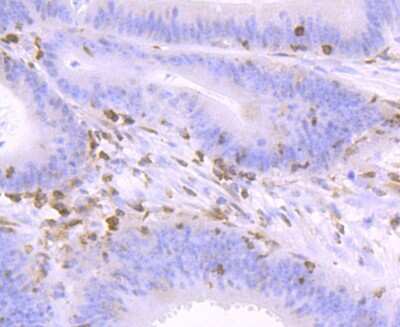Immunohistochemistry-Paraffin: NFATC2/NFAT1 Antibody (JA11-08) [NBP2-66974] - Analysis of paraffin-embedded human colon cancer tissue using anti-NFAT1 antibody. Counter stained with hematoxylin.