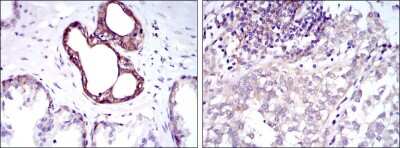 Immunohistochemistry-Paraffin: NFkB p105/p50 Antibody (5D10) [NBP2-22202] - Immunohistochemical analysis of paraffin-embedded prostate tissues (left) and bladder cancer tissues (right) using NFkB p105/p50 mouse mAb with DAB staining.
