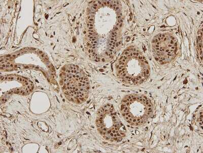 Immunohistochemistry-Paraffin: NFkB p105/p50 Antibody (A2-7) [NBP2-66976] - Analysis of human breast carcinoma tissue using anti- NFkB p105 / p50 antibody. Counter stained with hematoxylin.