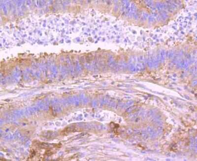Immunohistochemistry-Paraffin: NFkB2/NFkB p100 Antibody (JM82-03) [NBP2-66977] - Analysis of paraffin-embedded human colon cancer tissue using anti-NFkB p100 antibody. Counter stained with hematoxylin.