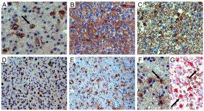 Immunohistochemistry: NG2/MCSP Antibody [NBP1-89682] - NG2/CSPG4 immunohistochemistry in oligodendroglial tumors. (A) WHO grade II oligodendroglioma. Isolated tumor cells (arrow) with NG2/CSPG4+ cell membranes; DAB, 400x. (B) WHO grade III oligodendroglioma. NG2/CSPG4-positive area with honeycomb appearance; DAB, OM 400x. (C) Id. Isolated CNPase-positive tumor cells in infiltration area; DAB, OM 400x. (D) Id. Sox10-positive tumour cells; DAB, OM 200x. (E) Id. NG2/CSPG4-positive reactive astrocytes inside the tumor; DAB, OM 200x. (F) Id. GFAP-positive reactive astrocytes (arrow) intermingled with GFAP-negative tumor cells; DAB, OM 400x. (G) Id. GFAP-positive (alkaline phosphatase red) and mIDH1R132H-negative reactive astrocytes (arrow) intermingled with mIDH1R132H-positive (DAB) and GFAP-negative tumor oligodendrocytes (arrow); OM 400x. Image collected and cropped by CiteAb from the following publication (//www.mdpi.com/2073-4409/9/6/1538) licensed under a CC-BY license.