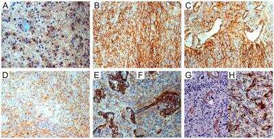 Immunohistochemistry: NG2/MCSP Antibody [NBP1-89682] - (A) WHO grade II astrocytoma. NG2/CSPG4-negative tumor cells and -positive reactive astrocytes; DAB, original magnification (OM) 200x. (B) IDH-wild type glioblastoma (GB). Area of NG2/CSPG4-positive cells; DAB, OM 200x. (C) Id. NG2/CSPG4-positive tumor cells and reactive astrocytes oriented on vessels; DAB, OM 200x. (D) Id. NG2/CSPG4-negative area of necrosis; DAB, OM 200x. (E) Id. NG2/CSPG4-positive vascular pericytes in microvascular proliferations; DAB, OM 200x. (F) Id. NG2/CSPG4-positive pericytes in a glomerulus with sprout; DAB, OM 200x. (G) Id. a-SMA-positive pericytes in infiltration area; DAB, OM 200x. (H) Id. PDGFRB-positive pericytes in hyperproliferative area. Image collected and cropped by CiteAb from the following publication (//www.mdpi.com/2073-4409/9/6/1538) licensed under a CC-BY license.