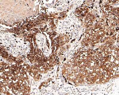 Immunohistochemistry-Paraffin: NG2/MCSP Antibody (JM10-13) [NBP2-66979] - Analysis of paraffin-embedded human malignant melanoma tissue using anti-NG2/MCSP antibody. The section was pre-treated using heat mediated antigen retrieval with Tris-EDTA buffer (pH 9.0) for 20 minutes.The tissues were blocked in 1% BSA for 30 minutes at room temperature, washed with ddH2O and PBS, and then probed with the primary antibody (1/400) for 30 minutes at room temperature. The detection was performed using an HRP conjugated compact polymer system. DAB was used as the chromogen. Tissues were counterstained with hematoxylin and mounted with DPX.