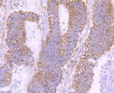 Immunohistochemistry-Paraffin: NGFI-B alpha/Nur77/NR4A1 Antibody (JM59-11) [NBP2-66980] - Analysis of paraffin-embedded human colon cancer tissue using anti-NUR77 antibody. Counter stained with hematoxylin.