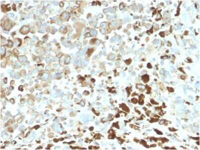 Immunohistochemistry-Paraffin: NGFR/TNFRSF16/p75NTR Antibody (NGFR/2550R) - Azide and BSA Free [NBP3-08566] - Formalin-fixed, paraffin-embedded human Melanoma stained with NGFR/TNFRSF16/p75NTR Rabbit Recombinant Monoclonal Antibody (NGFR/TNFRSF16/p75NTR/2550R).