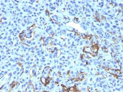 Immunohistochemistry-Paraffin: NGFR/TNFRSF16/p75NTR Antibody (NGFR5 + NTR/912) - IHC-Prediluted [NBP2-48298] - Human Melanoma stained with NGFR Monoclonal Antibody (NGFR5 + NTR/912).