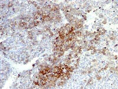 Immunohistochemistry-Paraffin: NGFR/TNFRSF16/p75NTR Antibody (NGFR5 + NTR/912) - IHC-Prediluted [NBP2-48298] - Human Melanoma stained with NGFR Monoclonal Antibody (NGFR5 + NTR/912).